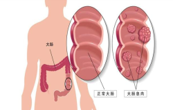 腸息肉會(huì)癌變嗎？腸鏡檢查出腸息肉千萬別大意！