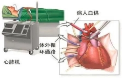 心外科團(tuán)隊(duì)中，體外循環(huán)那些事