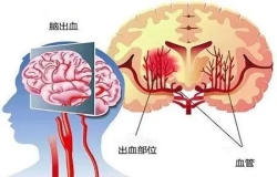 原來高血壓和腦出血有這樣的關(guān)系......高血壓別不當(dāng)回事，警惕變成腦出血！