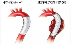 《問心》熱播！全網(wǎng)熱議的主動脈夾層，您了解嗎？